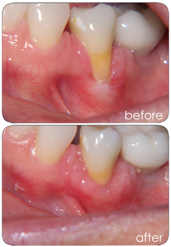 Subepithelial Connective Tissue Graft Lake Charles, LA Raymond J